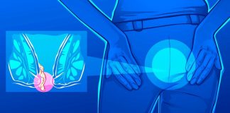 Можно ли как-то вылечить геморрой? Можно ли как-то вылечить геморрой?