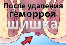 Шишка после удаления геморроя После удаления геморроя вылезла шишка