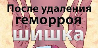 Шишка после удаления геморроя После удаления геморроя вылезла шишка