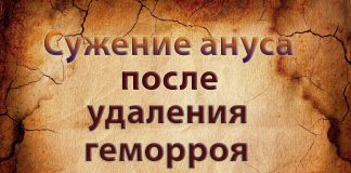 Сужение заднего прохода после удаления геморроя Сужение заднего прохода после удаления геморроя